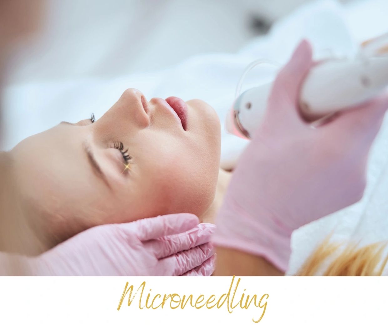 Microneedling
